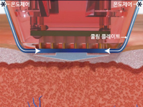 마이크로 니들