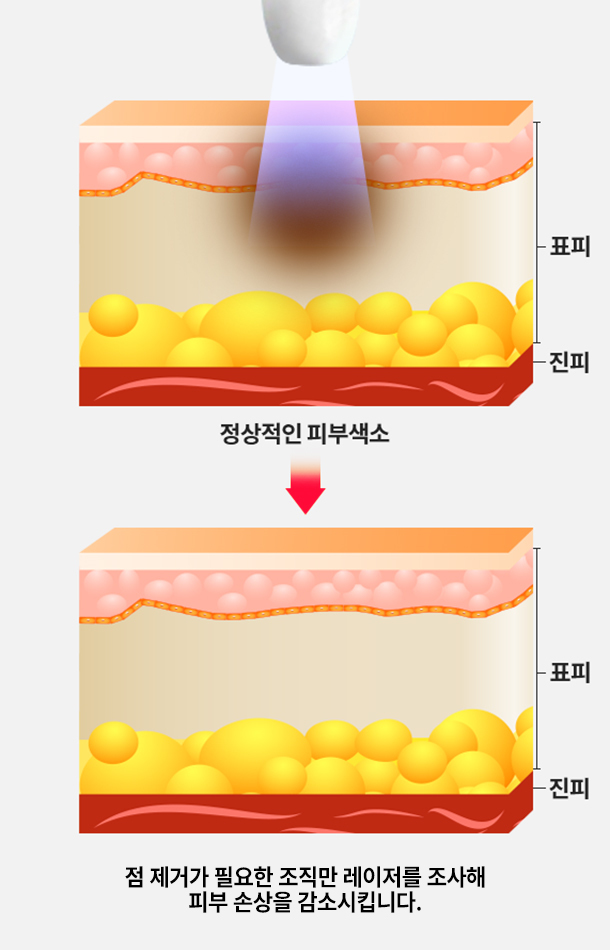 하남스타 잡티 제거